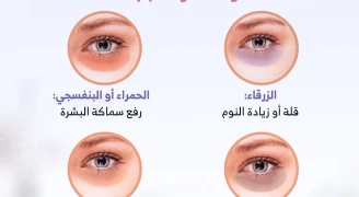 الهالات السوداء.. أنواعها وأسبابها