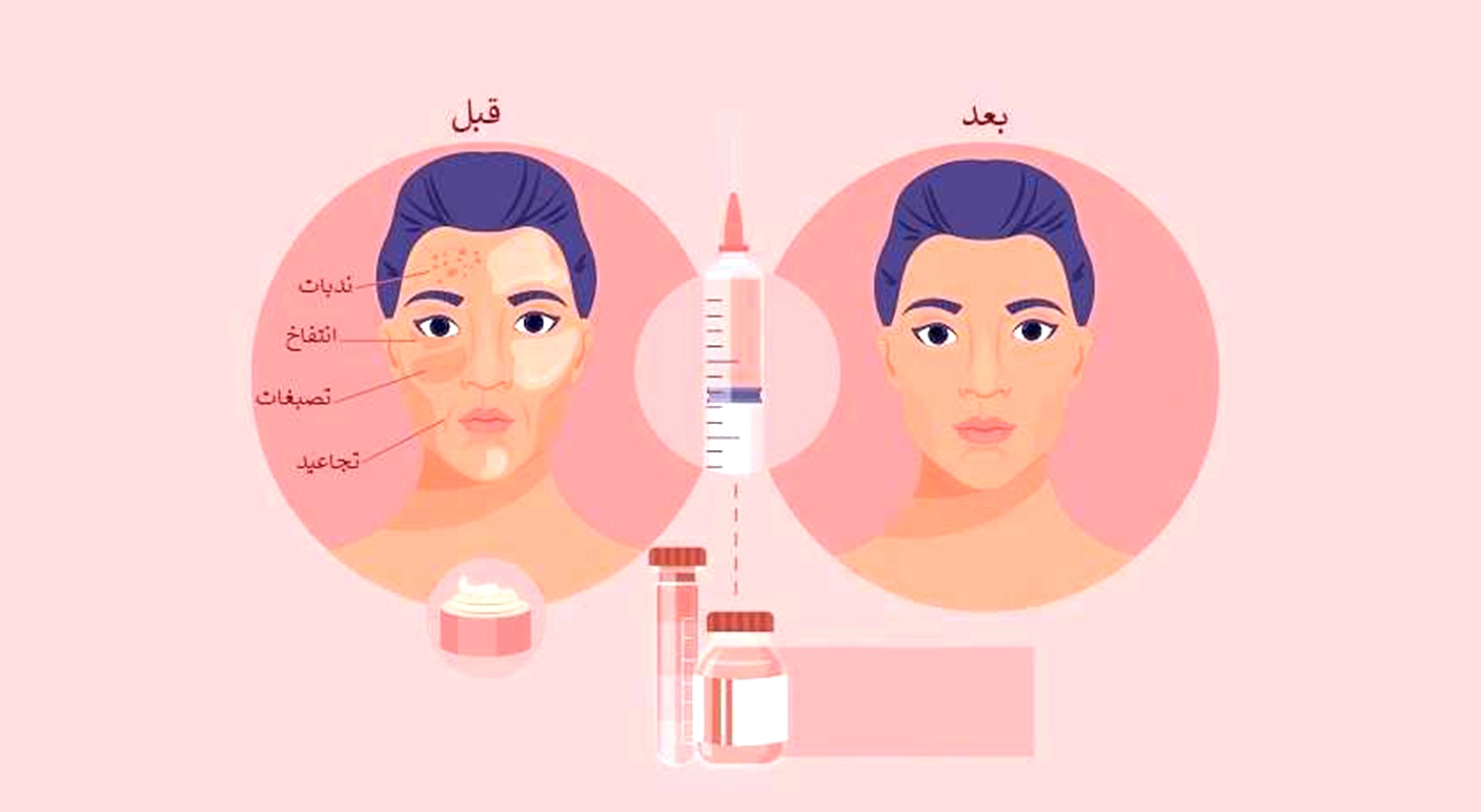 الميزوثيرابي لعلاج للشعر والبشرة
